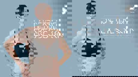 My Extreme Excess Skin S2 2017