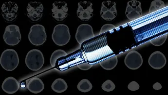 Contraception and Meningiomas: What To Know